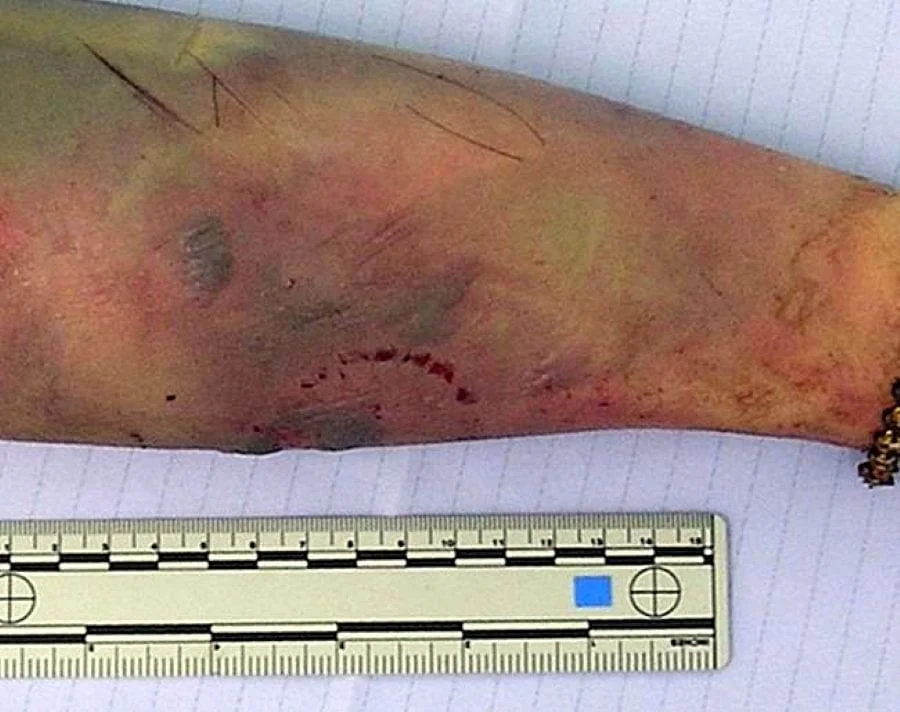 Права рука вбитої зі слідами укусу